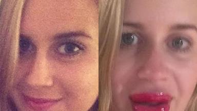 Aussie girl tries to get 'Kylie Jenner lips'