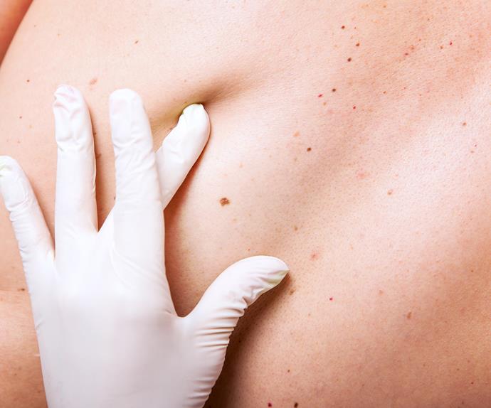 Doctor looking at skin cancer
