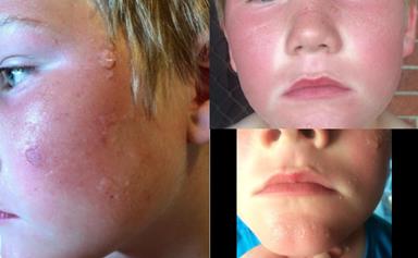 Boy suffers second degree burn after applying sunscreen