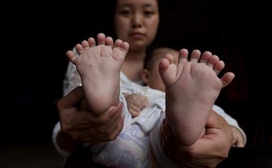 Chinese baby born with 31 fingers and toes