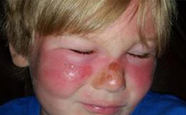 Boy suffers second degree burns after applying popular 50SPF sunscreen