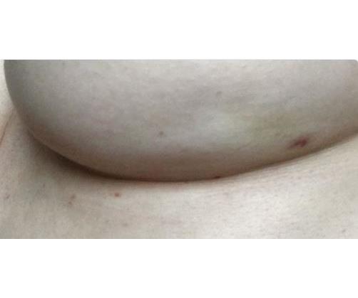 Woman shares photo of breast cancer 