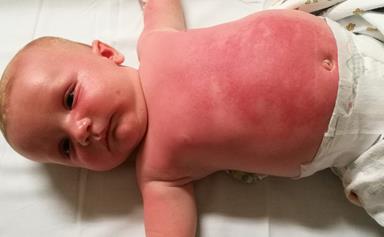 Baby hospitalised after alleged reaction to Cancer Council Peppa Pig sunscreen