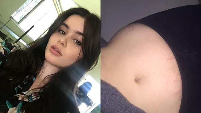 <strong>Barbie Ferreira</strong><br><br> The teen model shared a snap of her stretch marks to her 373,000 Instagram followers, captioning it: "Mi lil stripes are out here, soothing them with vitamin e oil n noticing how cute my body can be despite lil changes !!!"<br><br> Instagram: <a href="https://www.instagram.com/p/BN6E2K7Bvg-/?taken-by=barbienox&hl=en">@barbienox</a>