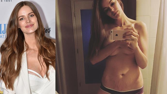 <strong>Robyn Lawley</strong><br><br> Model Robyn Lawley took to Facebook to write an impassioned open letter about her stretch marks after a salacious story was written about her on a UK gossip site. "They are some bad ass tiger stripes. And I earned them," she wrote. You can read the whole thing <a href="https://www.facebook.com/175775249378/photos/a.10150208136009379.331958.175775249378/10153779423284379/?type=3">here</a>.
