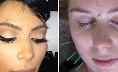 This is why you should let someone stick needles in your face