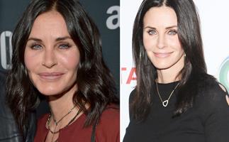 Courteney Cox got her fillers and Botox dissolved