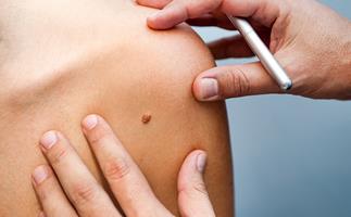 New online tool can measure your melanoma risk