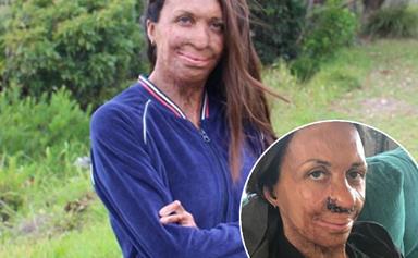 Turia Pitt reveals she's recovering from a nose reconstruction surgery with new selfie
