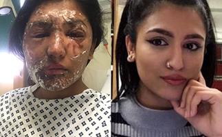 Model attacked with acid on her 21st birthday shows her amazing recovery one year on