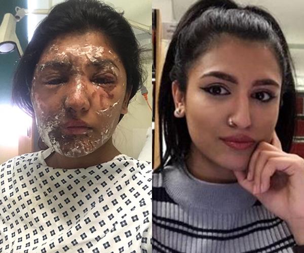 Model attacked with acid on her 21st birthday shows her amazing recovery one year on