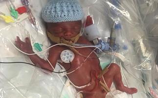 REAL LIFE: Doctors put my premature newborn in a plastic bag