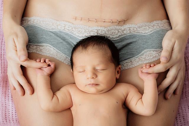 Do caesarean sections cause autism or ADHD?