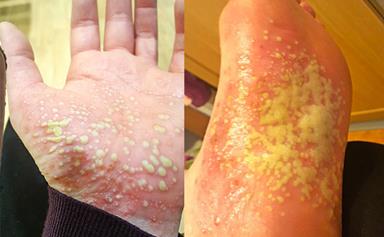 Real life: My psoriasis made my skin fall off and was so painful I couldn't walk