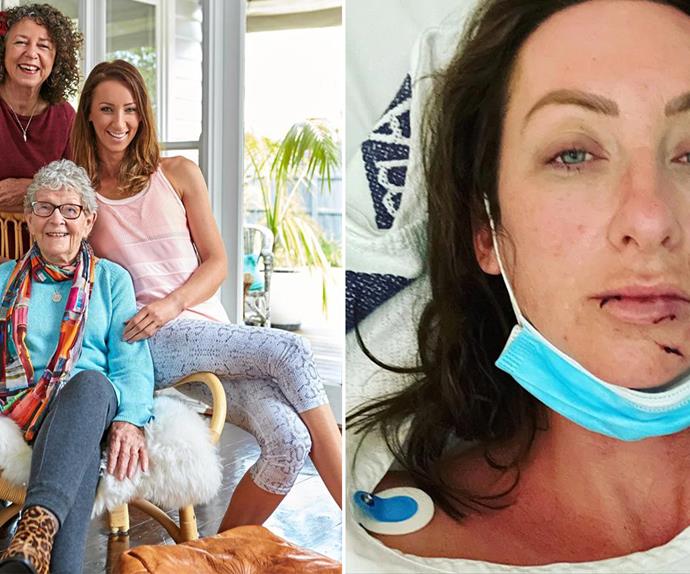 Gogglebox star Isabelle Silbery suffers facial injuries and a broken jaw after a horrific Christmas accident