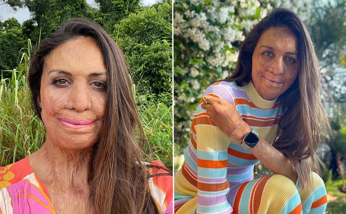 Turia Pitt's touching message of hope to those affected by floods and the war in Ukraine