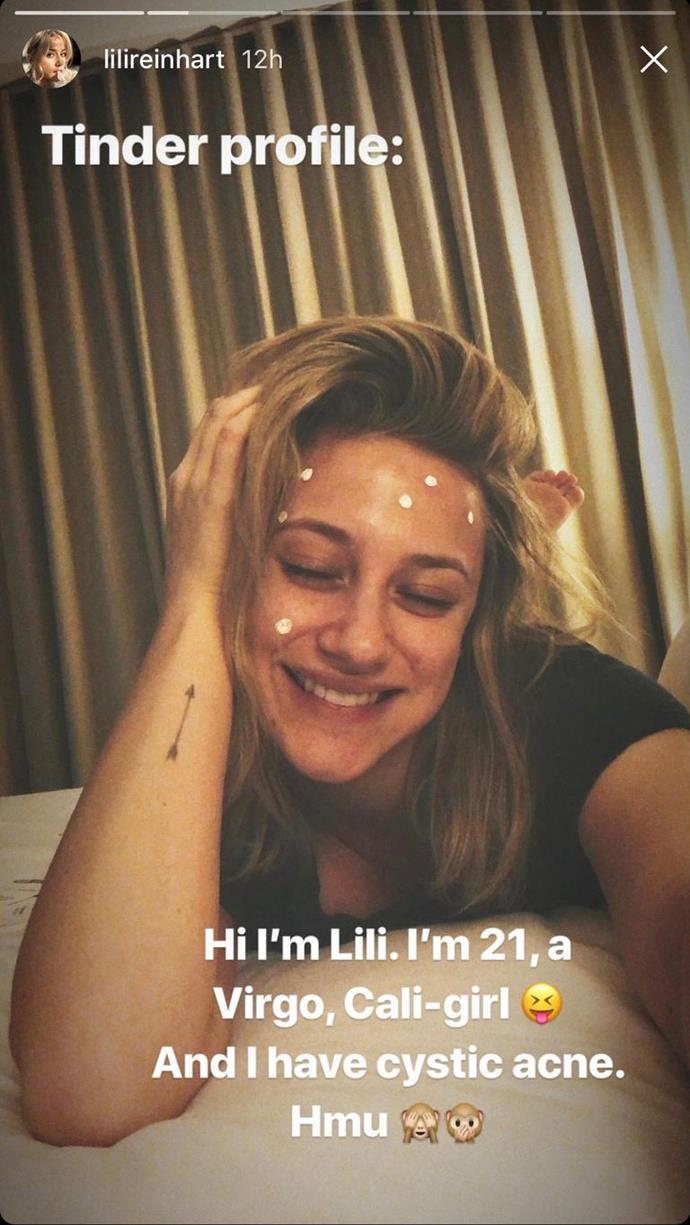 **Lili Reinhart:** *Riverdale* star Lili Reinhart shared a makeup-free selfie on her Instagram Story stylised as a Tinder profile. "Tinder profile: Hi I'm Lili. I'm 21, a virgo, Cali-girl. And I have cystic acne. Hmu," she wrote. The star has opened up about her struggles with acne since high school before. "Every time I have a big cystic pimple or something, it very much triggers that part of me where I don't want to look at myself in the mirror," she told [*Teen Vogue*](https://www.teenvogue.com/story/lili-reinhart-st-ives-interview|target="_blank") last August. "As I've gotten older, it's a matter of realising that I can't let a pimple on my face decide what I do and where I go."