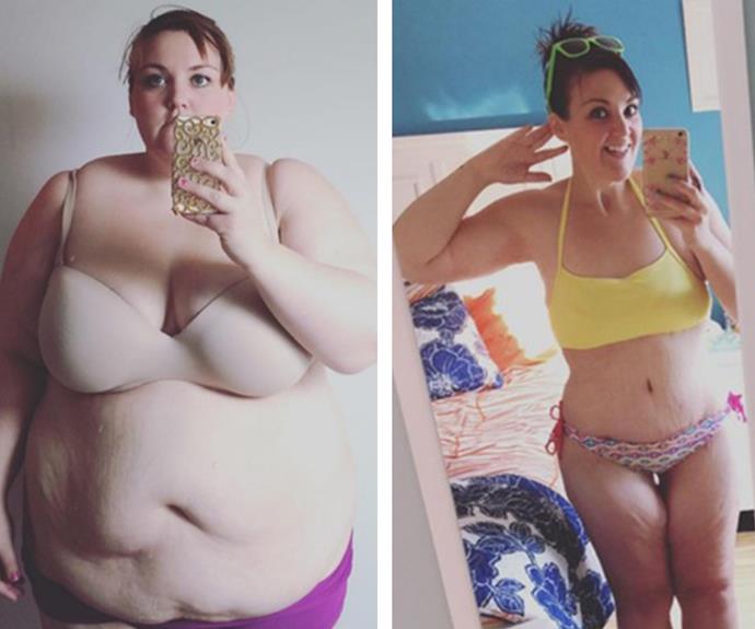 Once her weight reached almost 180kg in 2014, 29-year-old teacher Mallory Buettner decided it was time for a change. She turned to a diet of healthy whole foods before her doctor recommended a gastric bypass, so that her metabolism could better handle her new food intake. She shed 95kg as a result of the surgery and then had 4.5kg of [excess skin removed](https://www.nowtolove.com.au/news/real-life/excess-skin-removal-weight-loss-53543|target="_blank").