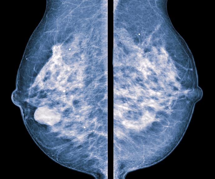 Like tissue, cancers appear white.