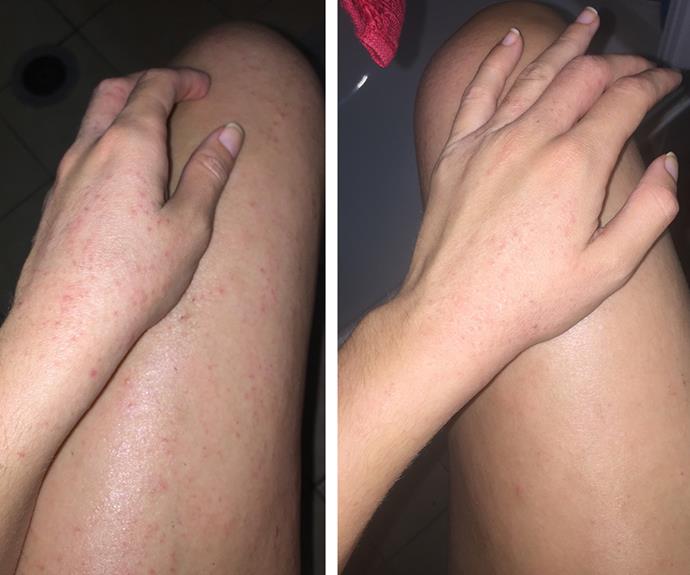 Before and after Madison found a way to manage her inflamed skin.