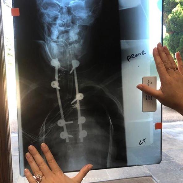 Princess Eugenie's X-ray photos gave a rare insight into her battle with scoliosis.