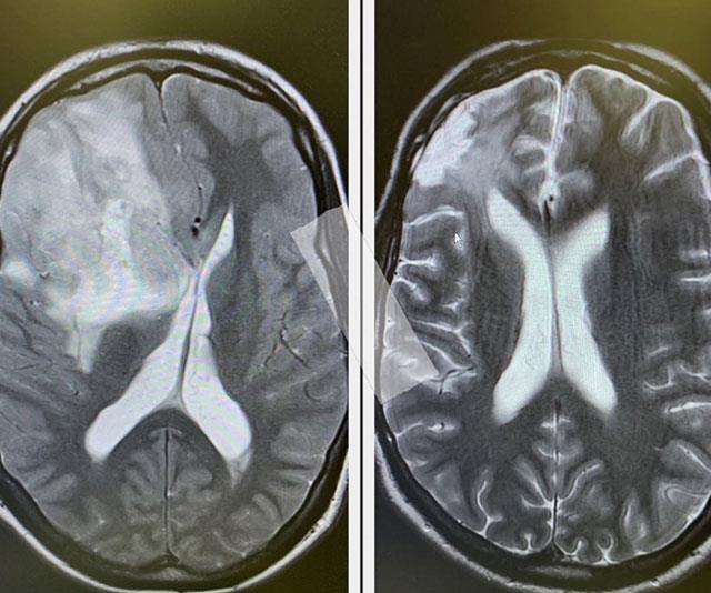 In August this year, Johnny shared two side-by-side brain scans, revealing he is cancer-free.