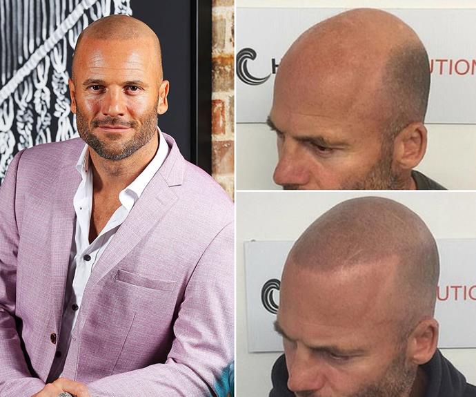 **Mike Gunner, season six**
<br><br>
Mike actually underwent his transformation just before he began filming his season of *MAFS*, undergoing scalp micropigmentation - which is the fancy name for a hair tattoo - before hitting our TV screens. These types of tattoos are used to disguise baldness, instead giving the impression of a shaved head. Mike was such a fan of the results that he's since trained to provide these tattoos himself!