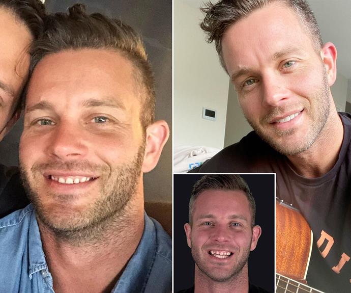 **Jake Edwards, season eight**
<br><br>
This groom also got veneers after facing cruel comments about his teeth on social media when his season aired. "Even on my 'wedding day' I copped a lot of grief. Yes they're cracked, chipped, tiny… you don't need to tell me, I know," Jake wrote on Instagram before showing off his transformed smile.