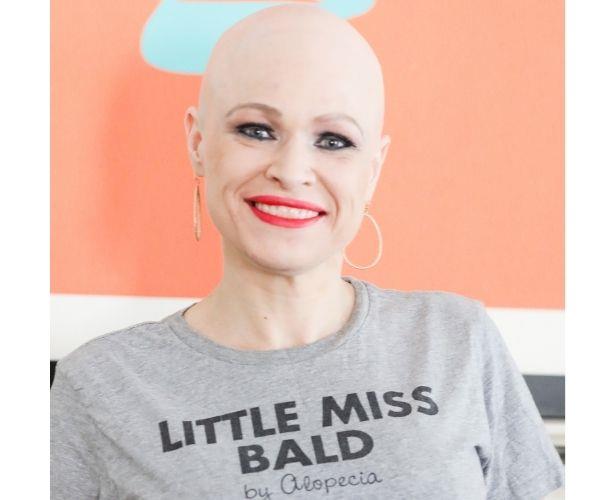 Learning to embrace alopecia.