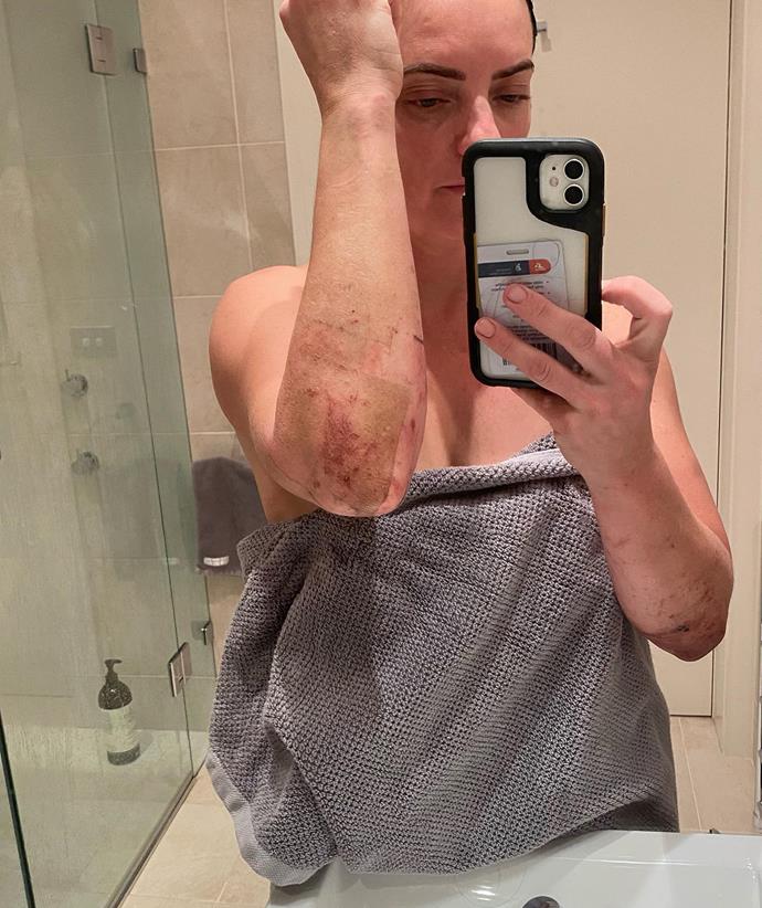 **Emma Husar's bruising**
<br><br>
Emma captioned this gory picture: "This was taken immediately after my first shower in days, I thought I was still dirty so I turned the taps back on and went in a second time.
<br><br>
"We filmed 24/7 and each ep is 43minutes, there's a lot you don't get to see! Namely the crawling through rocks, over rocks and doing burpees on rocks! Rocks for dayzzz! I have a couple of other morbid photos where my body took a hammering and the recovery as all the recruits do, stay tuned!"