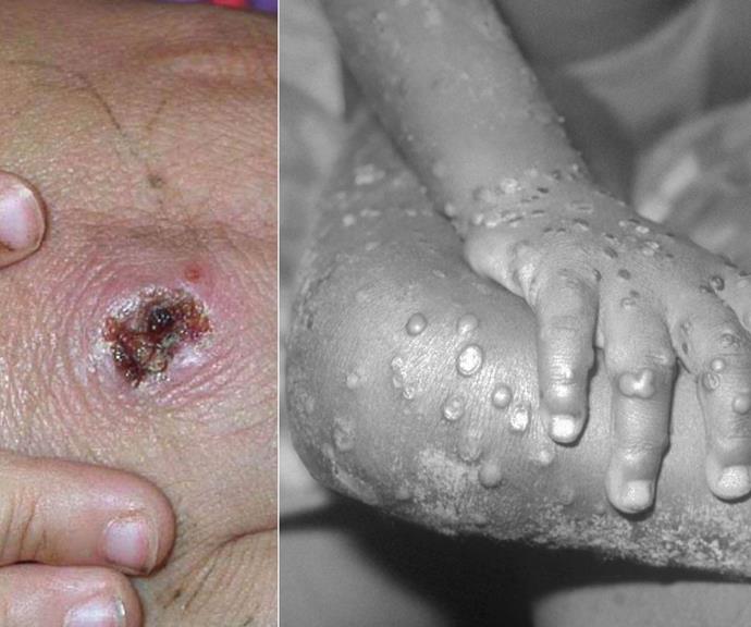 Monkeypox is spread through very close contact.