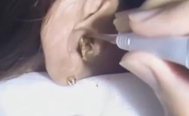 Watch a gigantic piece of earwax be removed