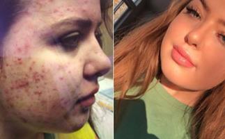 Teenager shares how she got rid of severe acne - and her tweet goes viral