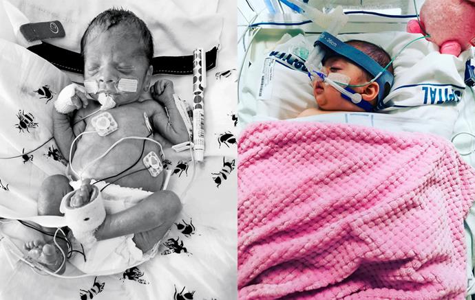 Left: premature baby Honour was "so tiny and see-through" says K'Lee.  Right: fighting off another crisis in hospital