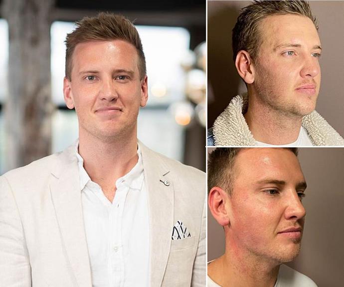**Liam Cooper, season eight**


After a fellow groom on his season took a swipe at Liam's looks, the star sought out a 'facial rejuvenation' procedure that used botox and filler injections to soften wrinkles and sculpt out his jawline. He showed off the results on Instagram with the caption: "I have always struggled with my jawline and I couldn't be happier with the end results."

(Image: Nine/Instagram)