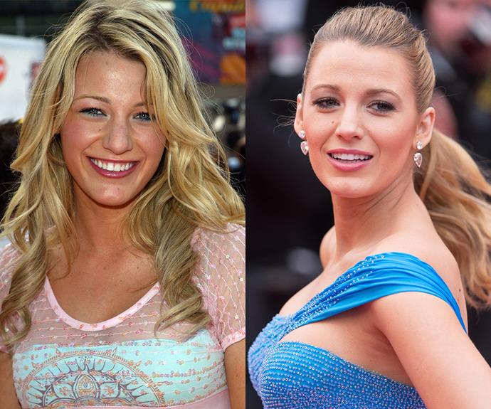 The year was 2005 and Blake Lively (L) was making her mark on the small screen with a much larger honker than she sports today. So what's the verdict? Dr James Southwell-Keely says Blake has "definitely" had a nose job. "Her nose is less broad through the middle and less bulbous at the tip," he tells us.